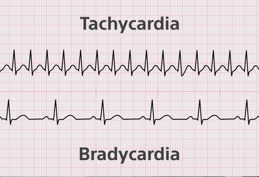 What is the Pacemaker Implantation Surgery Cost in Chennai?